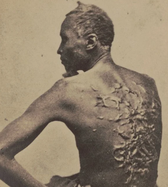 Why Do People Show Pictures Of Abortions? Historical photograph of an enslaved man with severe scarring on his back