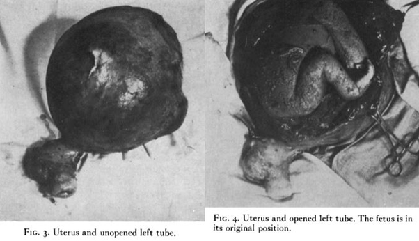 Historical medical figures showing a uterus and opened left fallopian tube