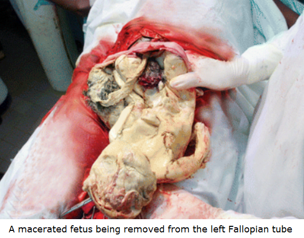 Medical photograph of a macerated fetus being removed from the left fallopian tube