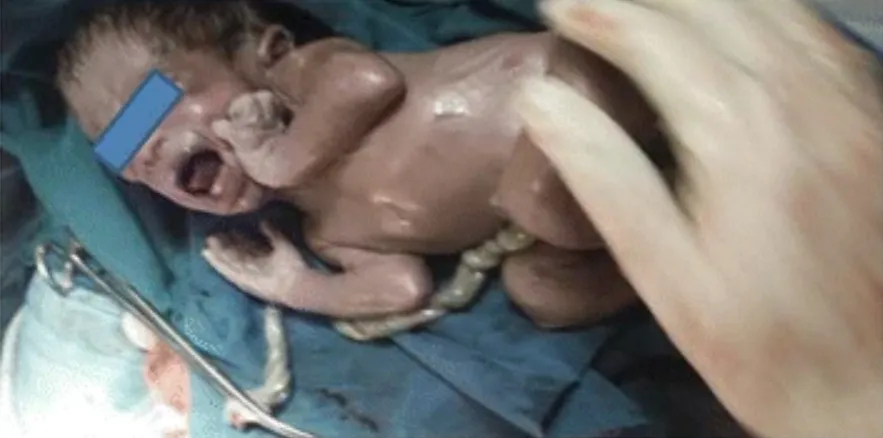 Ectopic Pregnancy: The Rare Hope Beyond Abortion Medical photograph of a living child immediately after an advanced abdominal pregnancy birth