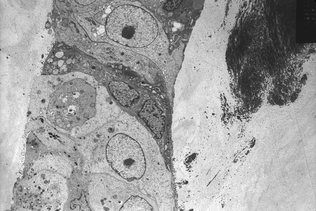 Black-and-white electron micrograph of a breast cancer cell.