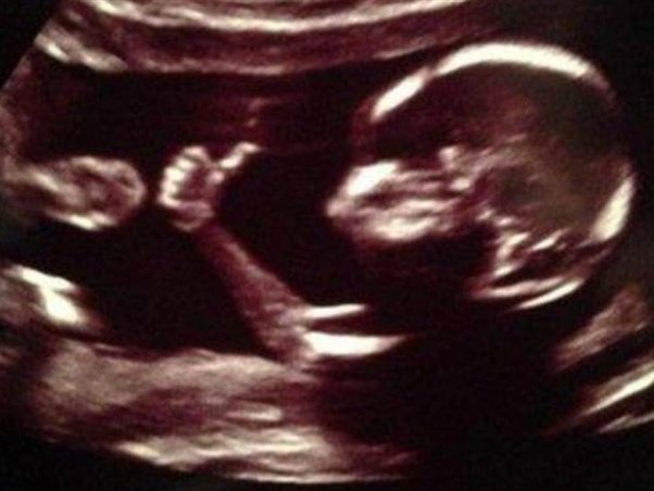 Prenatal ultrasound image